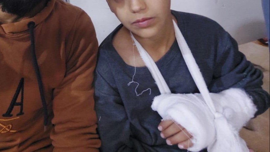 تعذيب طفل في مدرسة كفرحمرة.. كسور وكدمات وغضب