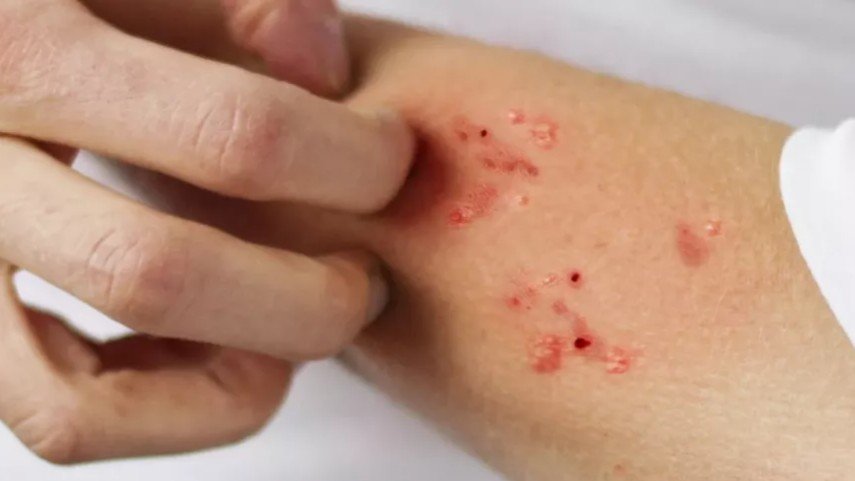 إصابات بالجرب في “المجتهد”.. وإجراءات عزل مشددة